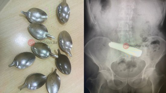 Bakıda bir nəfər 9 ədəd qaşıq uddu (FOTO)